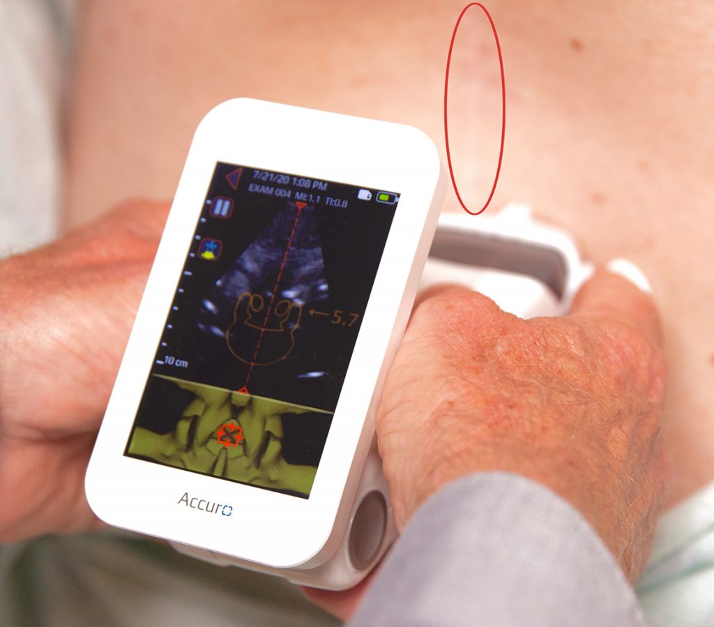 Accuro identifies compressed epidural space