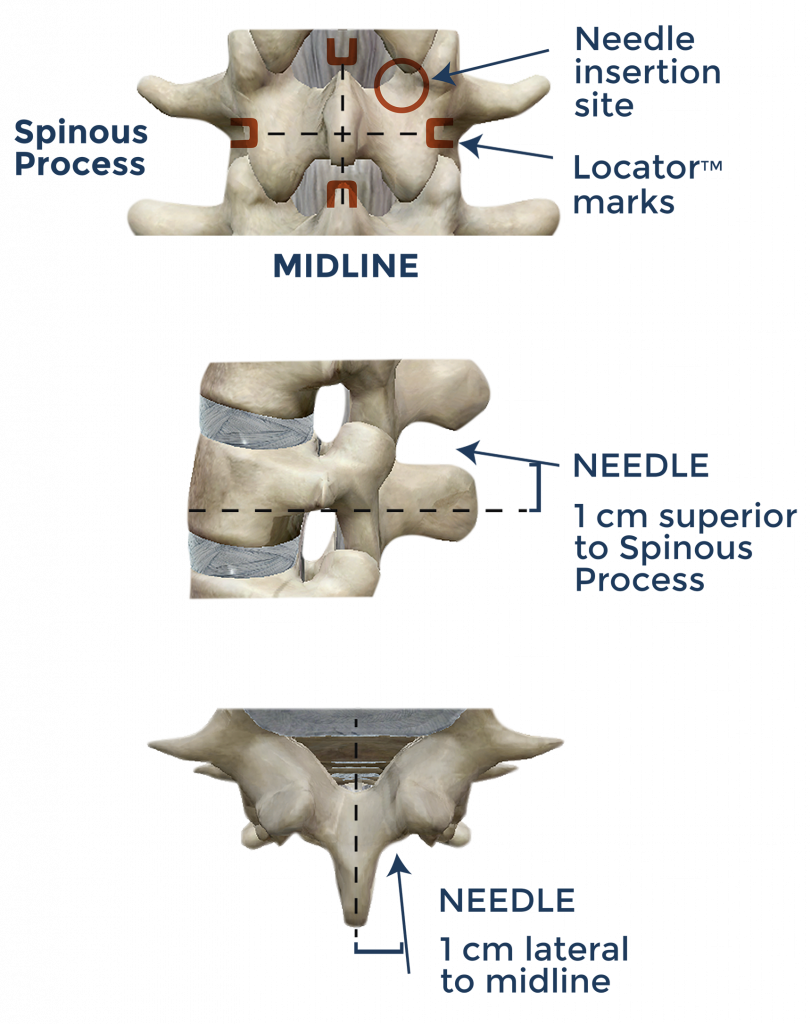 paramedian lumbar epidural technique