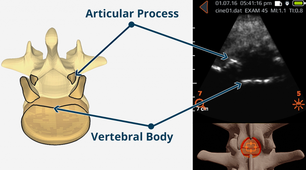 Accuro automated overlay — interlaminar space